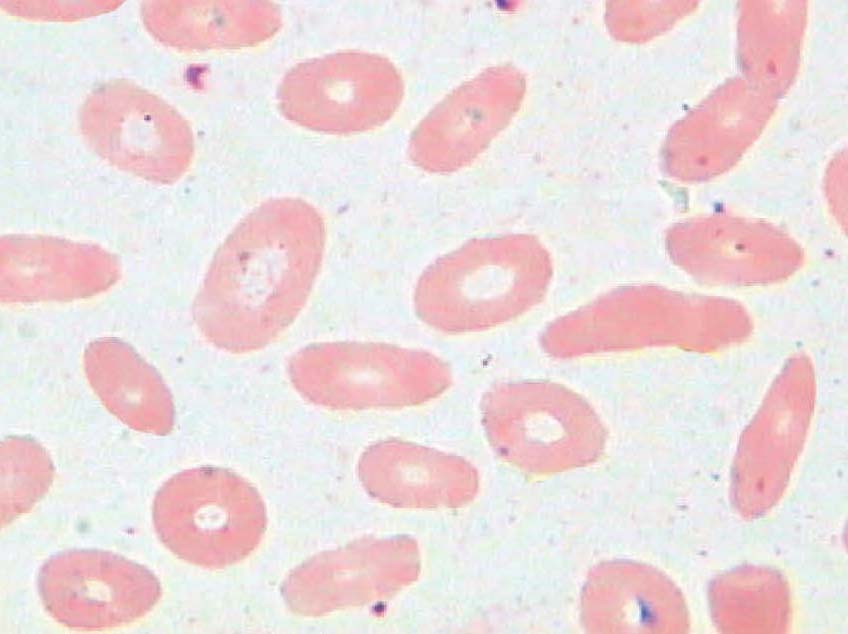 椭圆形红细胞